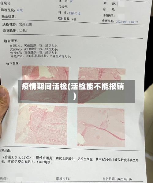 疫情期间活检(活检能不能报销)-第1张图片